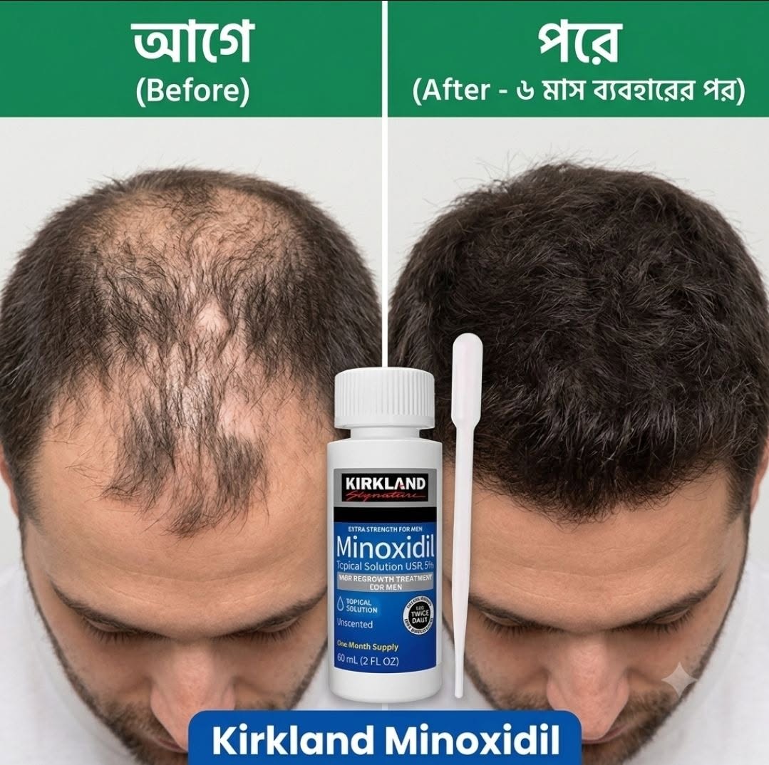 Kirkland Minoxidil 5% Solution (60ml × 2 Bottles) – 2 Month Supply for Hair Regrowth | Original USA Formula in Bangladesh
